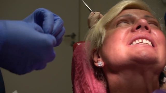 Последовательная фиксация виниров