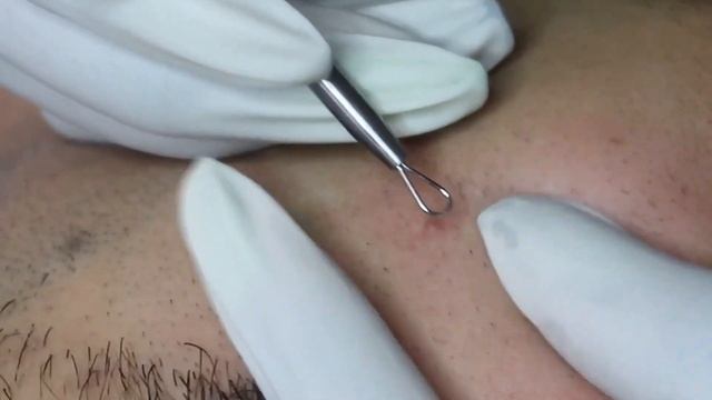 Чистка Кожи у Косметолога. Выдавливание Прыщей. Удаление Черных Точек и Угрей. 2022 - №6 смотреть онлайн