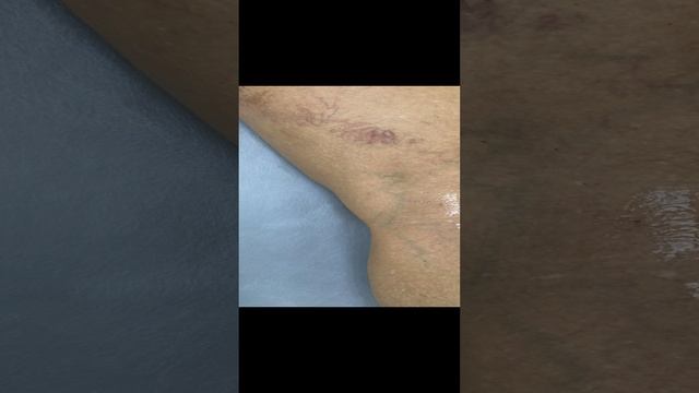 Сосудистая сетка на ноге. Как избавиться от сосудистой сетки? Флеболог Москва. Лечение вен. смотреть онлайн