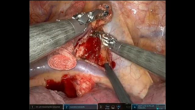 Robotic right paratracheal lymph node dissection смотреть онлайн