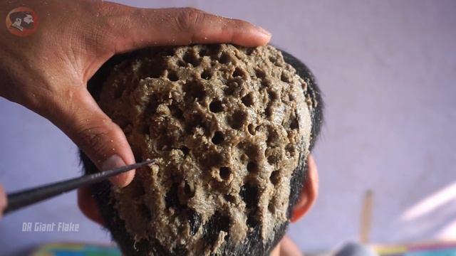 OMG!! Lot Of Tiny Worms Removing | Dandruff Scratching #1155 смотреть онлайн