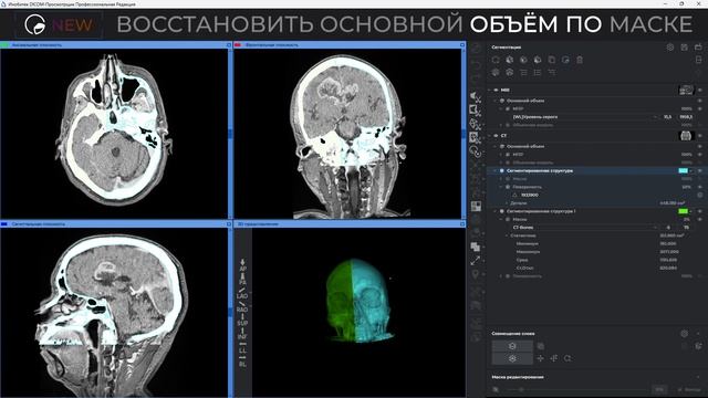 Панель сегментации в Inobitec DICOM Viewer смотреть онлайн