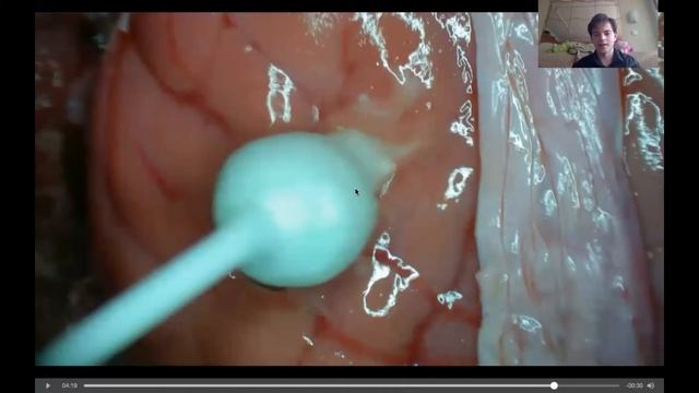 Субпиальная резекция и насечки