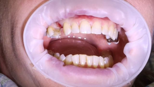 Удаление зуба с длинными корнями и одномоментно имплантат Osstem.
