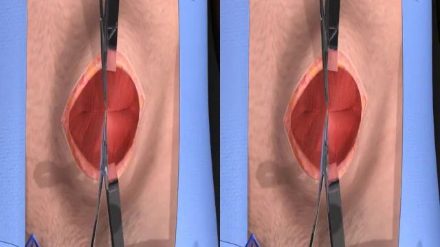 Open Hernia Procedure - 3D Stereographic Animation смотреть онлайн