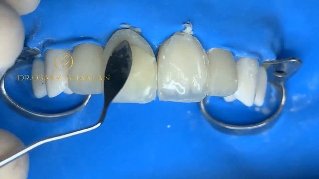 Direct compoSite veneers demo using simplified approach with unica matrix смотреть онлайн