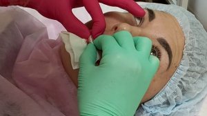 Коррекция губ филлером. Тоннельная техника.