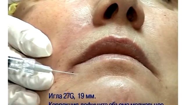 Мастер-класс "Коррекция носогубных складок и периоральной области филлером Regenyal Idea" смотреть онлайн