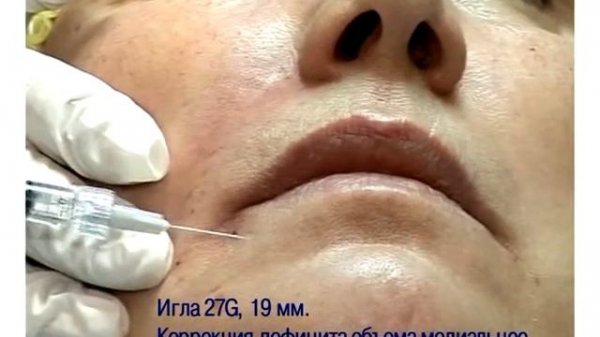 Мастер-класс "Коррекция носогубных складок и периоральной области филлером Regenyal Idea"