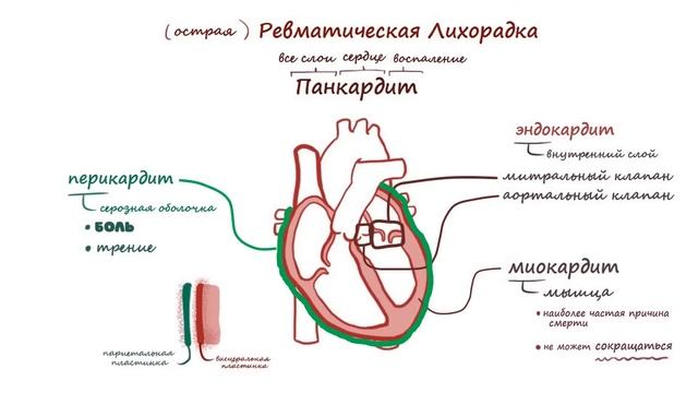 Острая ревматическая лихорадка - причины, симптомы (лекция)