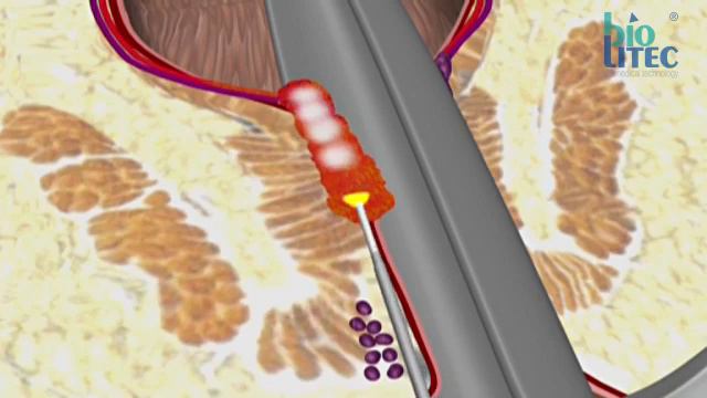 Лазерное удаление геморроя LHP смотреть онлайн
