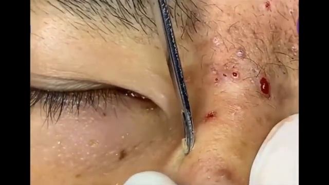 Blackheads on Nose and Forehead - Best Pimple Popping Videos смотреть онлайн