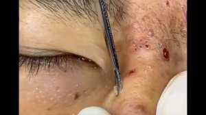 Blackheads on Nose and Forehead - Best Pimple Popping Videos