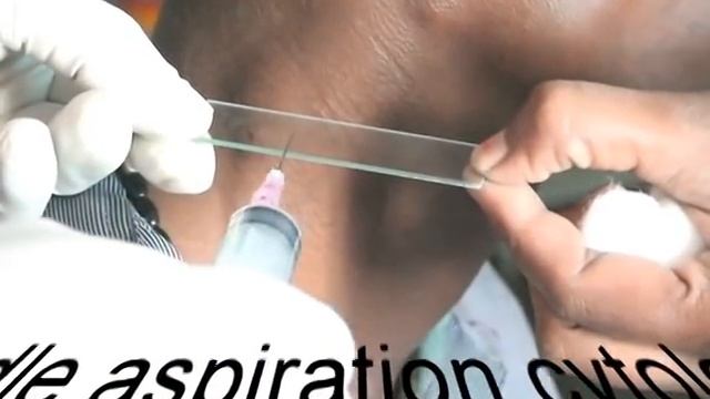 PRICKING THE NECK FNAC MULTIPLE CERVICAL LYMPHADENOPATHY смотреть онлайн