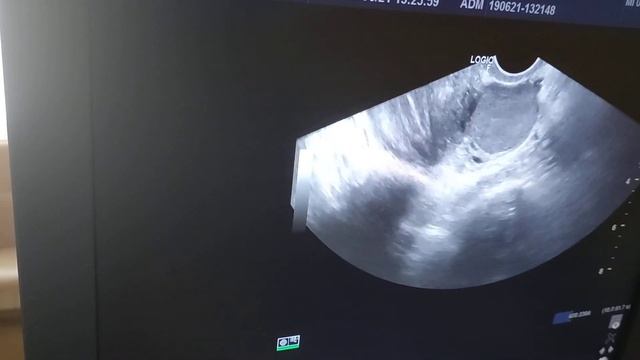 УЗИ органов малого таза. Эндометриоидная киста смотреть онлайн