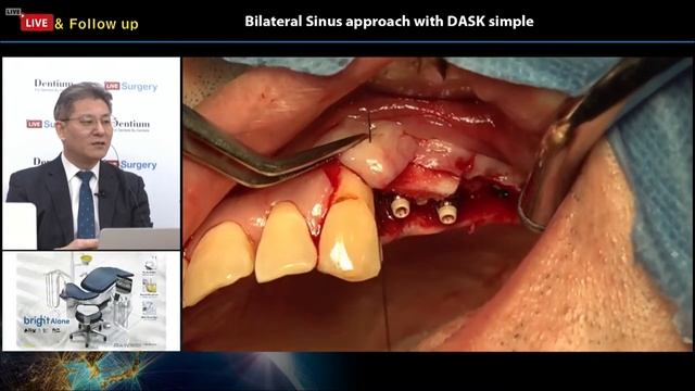 Bilateral Sinus Approach with DASK Simple смотреть онлайн