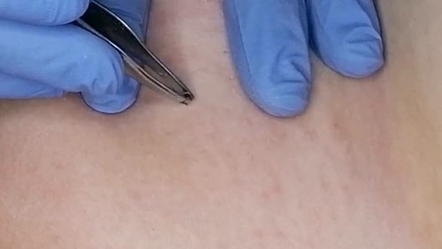 Шугаринг от Аллы. Оставшиеся Волоски. смотреть онлайн