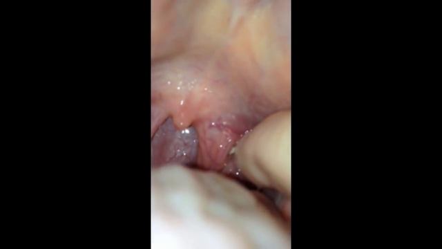 Tonsil Stone Removal смотреть онлайн