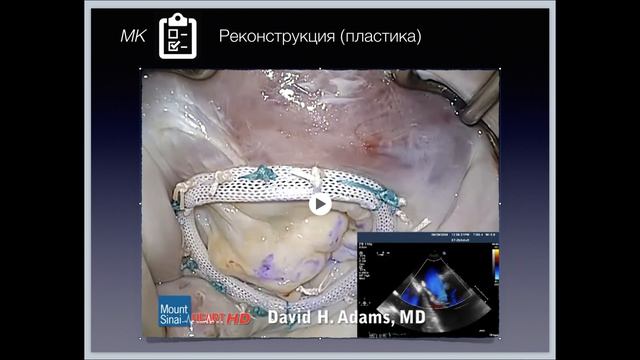 ППС-3-МН смотреть онлайн