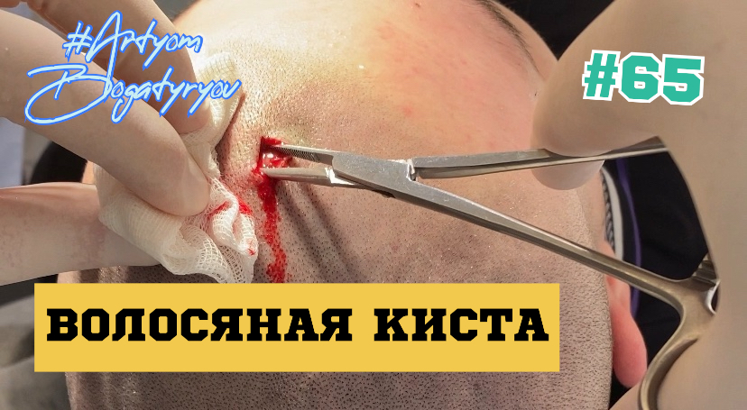 Волосяная киста