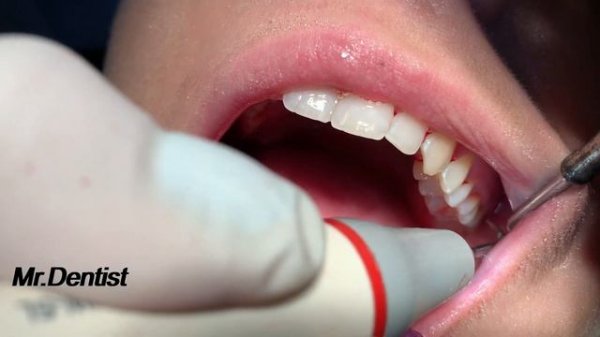 Teeth Cleaning  [ Removing Tartar And Plaque From The Teeth Surfaces ]