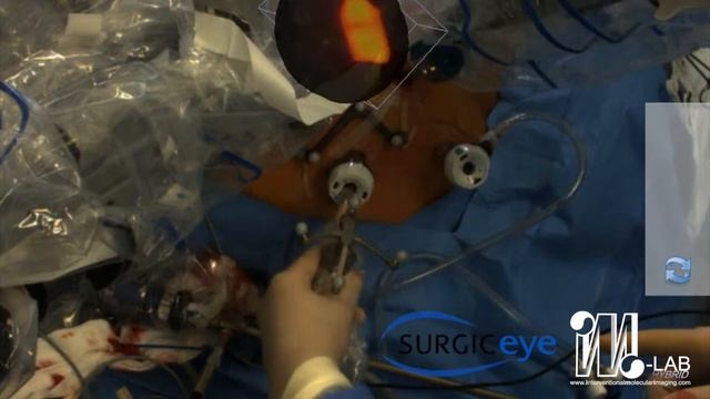 First Robotic SPECT for Minimally Invasive Sentinel Lymph Node Mapping смотреть онлайн
