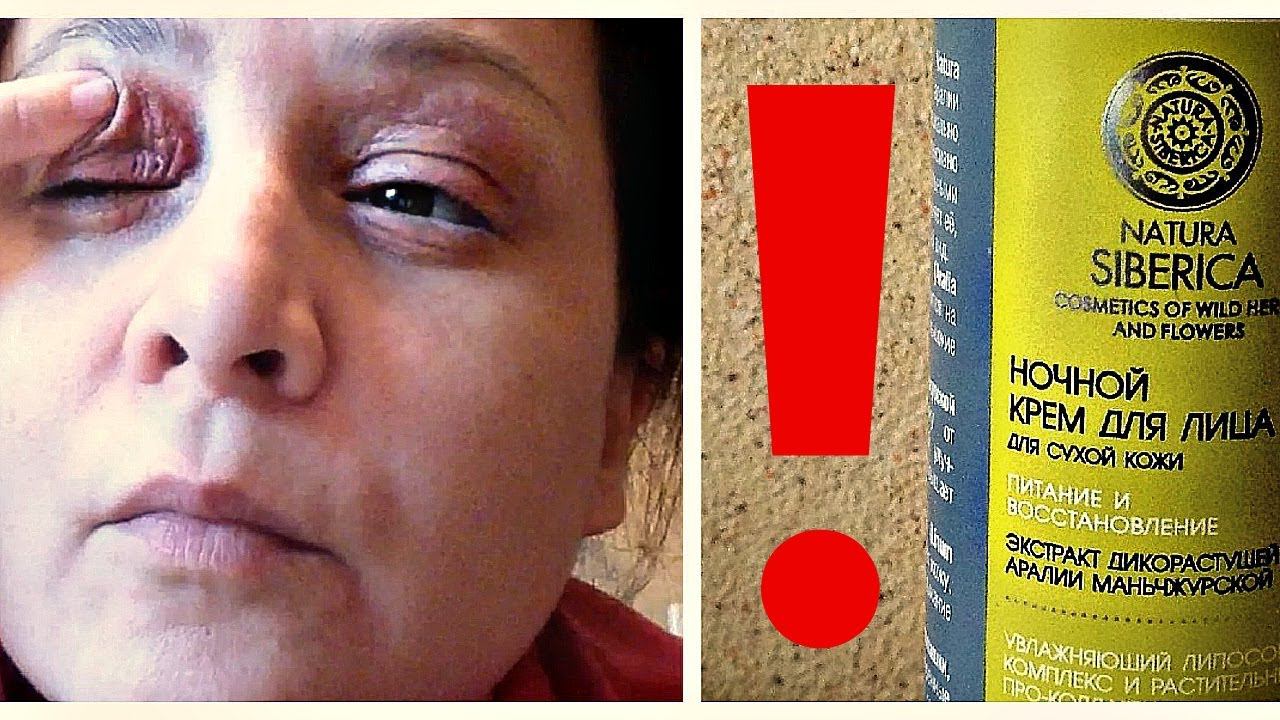 АЛЛЕРГИЯ на ГЛАЗАХ ОТ КРЕМА НАТУРА СИБЕРИКА * ЧЕМ я ВЫЛЕЧИЛА КОЖУ ЛИЦА от АЛЛЕРГИИ. смотреть онлайн