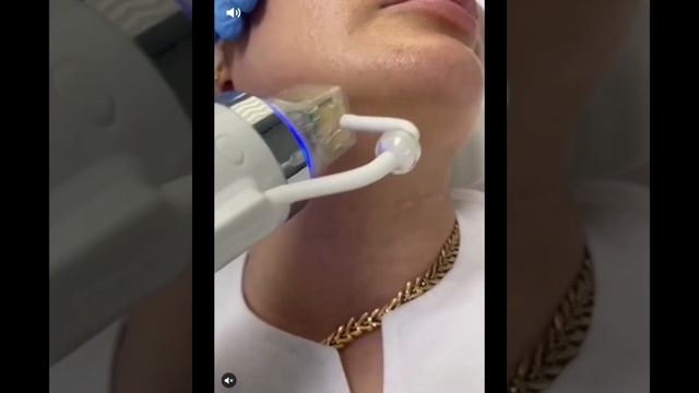 Микро игольчатый рф лифтинг смотреть онлайн