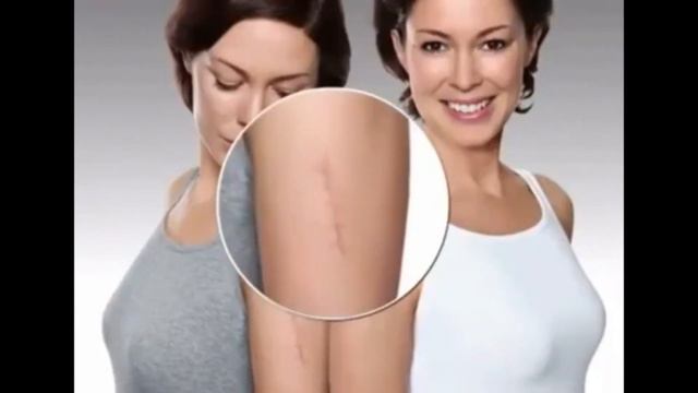 Kem trị sẹo nga Klirvin của Nga смотреть онлайн