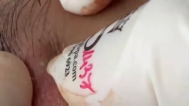 Blackhead Popping On Old Skin| Dr Pimple Popper Big Ear Blackheads