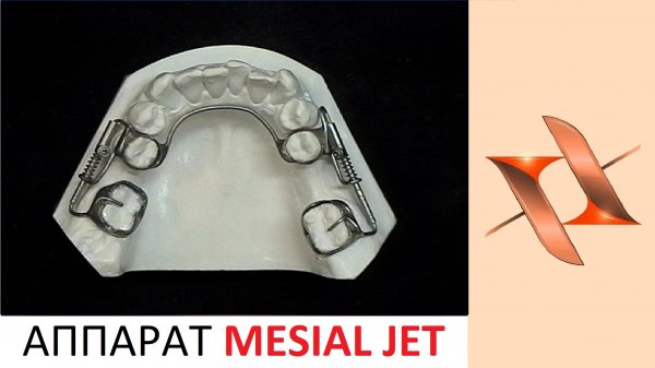 Аппарат Мезиал Джет (Mesial Jet).Ортодонтия.