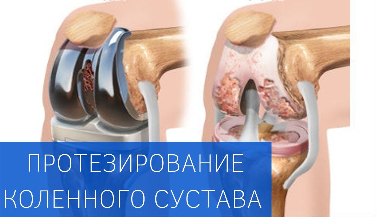 Протезирование коленного сустава, программа реабилитации смотреть онлайн