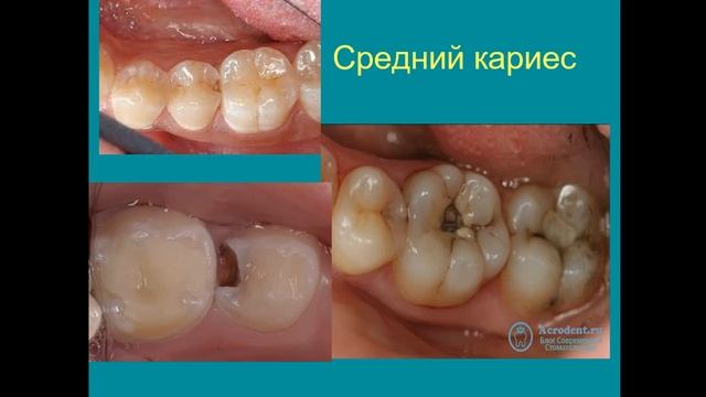 Лечение кариеса