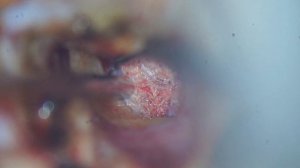 29 - Хирургическое лечение при отосклерозе