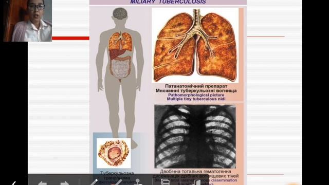 Classification of TB смотреть онлайн