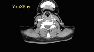 Лучевая анатомия гортани   |Лучевая диагностика|