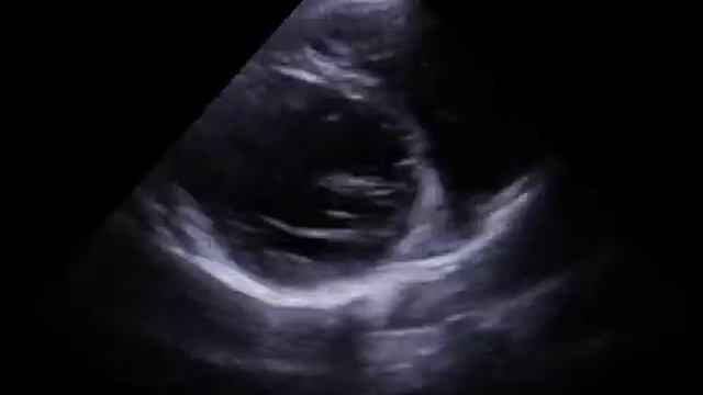 Множественные ложные хорды левого желудочка смотреть онлайн