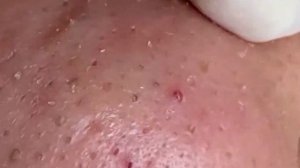 Чистим нос от чёрных точек и сальных пробок