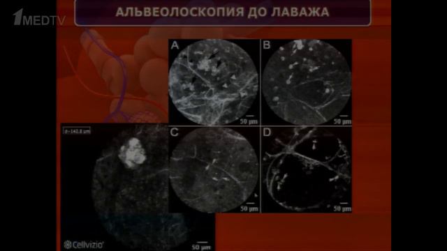 Роль конфокальной лазерной эндомикроскопии нижних дыхательных путей смотреть онлайн
