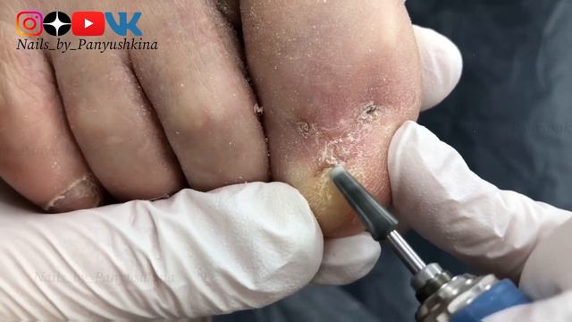 ПАЛЬЦЫ ПОСЛЕ ХИРУГА| ЗАЧИСТКА ОНИХОЛИЗИСА| ПОДОЛОГ МОСКВА| КУРСЫ ПЕДИКЮРА МОСКВА| АППАРАТНЫЙ ПЕДИКЮ смотреть онлайн