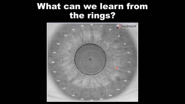 Medmont Webinar | Case Studies and Advanced Topography for Fitting Specialty Contact Lenses смотреть онлайн