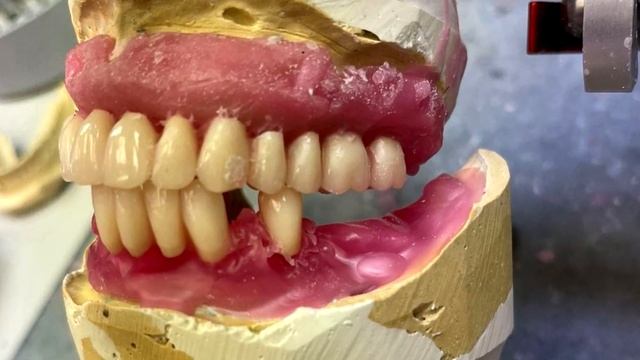 Восстановление утраченных зубов в виду ПАРОДОНТИТА Полным съёмным пластмассовым протезом смотреть онлайн