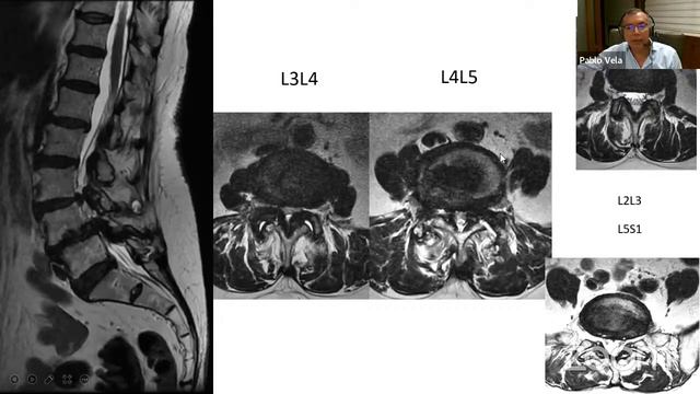 Universidad Flanc: Modulo Columna Vertebral смотреть онлайн