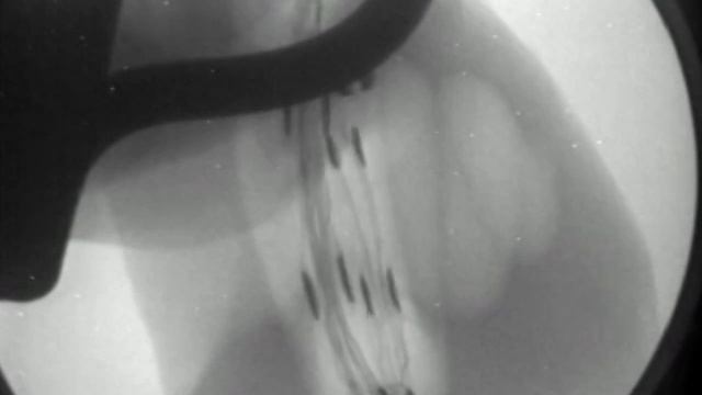 Cochlear Implant Surgery X-Ray Fluoroscopy Video—MED-EL смотреть онлайн