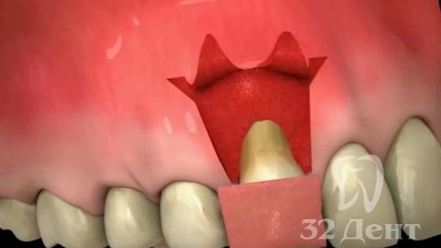 Пародонтология. Трансплантация десневой ткани. смотреть онлайн