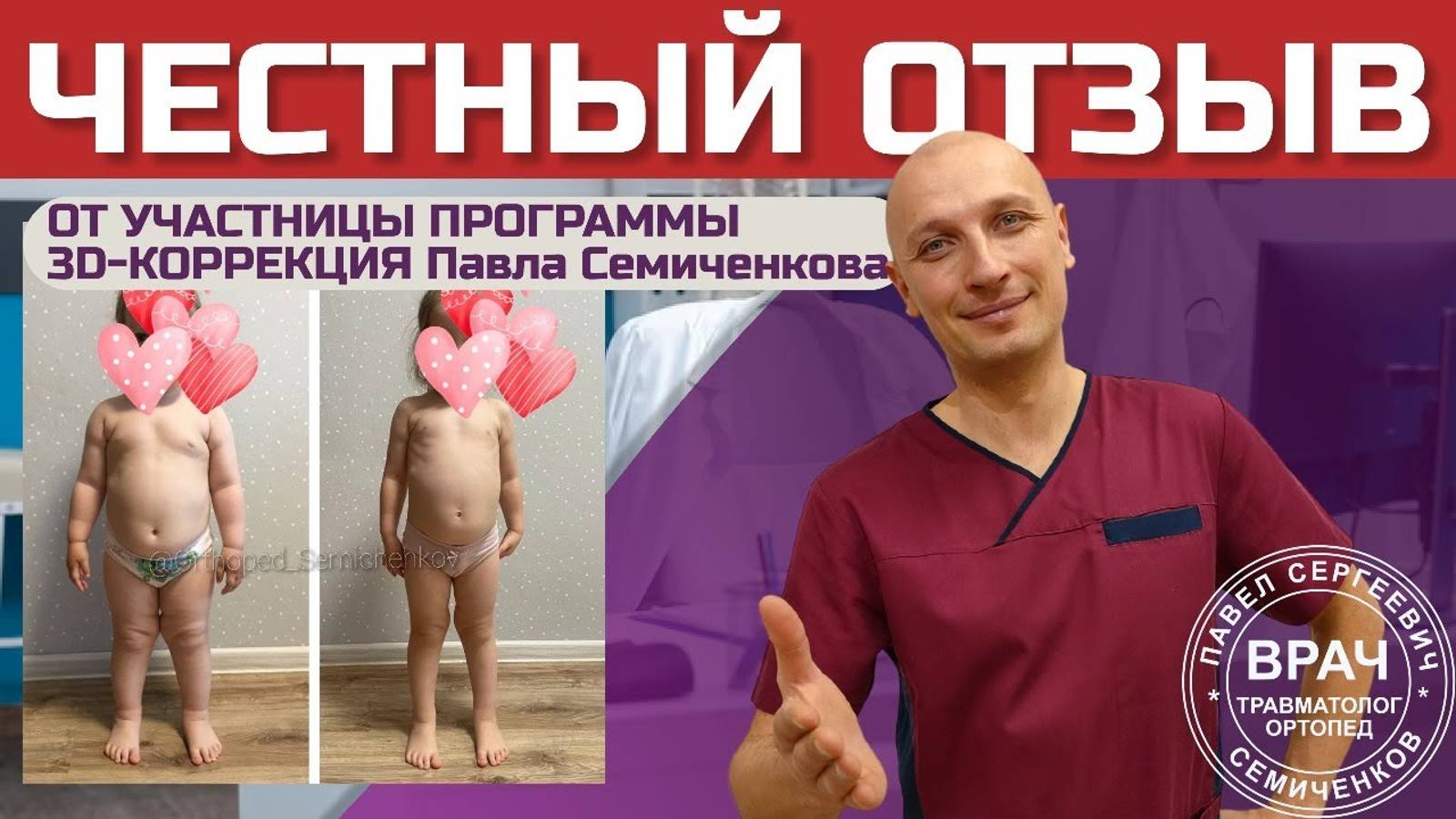 Коррекция вальгуса стоп_ честный отзыв об онлайн-занятиях и результатах