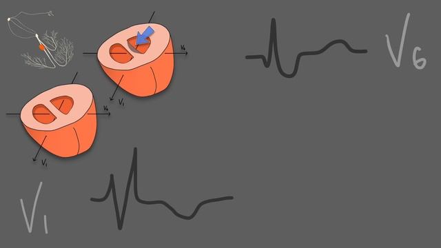 Блокада правой ножки пучка Гиса.