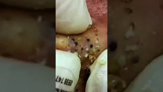 Выдавливания угрей на лице ,N2 (Squeezing Blackheads On The Face)