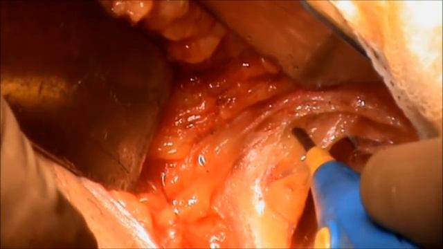 Axillary Dissection in Breast Conservation Surgery-Bloodless Whitefield Surg Dissection- R Talwar смотреть онлайн