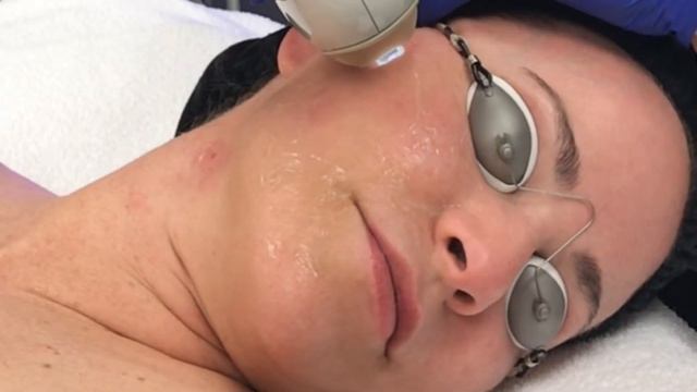 Limelight Laser Treatment смотреть онлайн